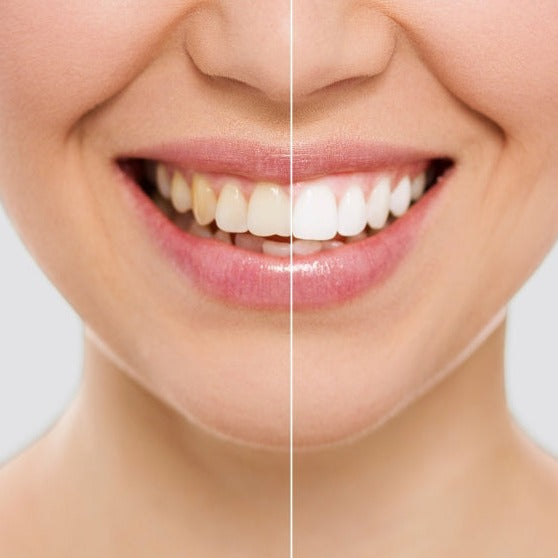 LÁPIZ BLANQUEADOR DE DIENTES CON FÓRMULA MEJORADA