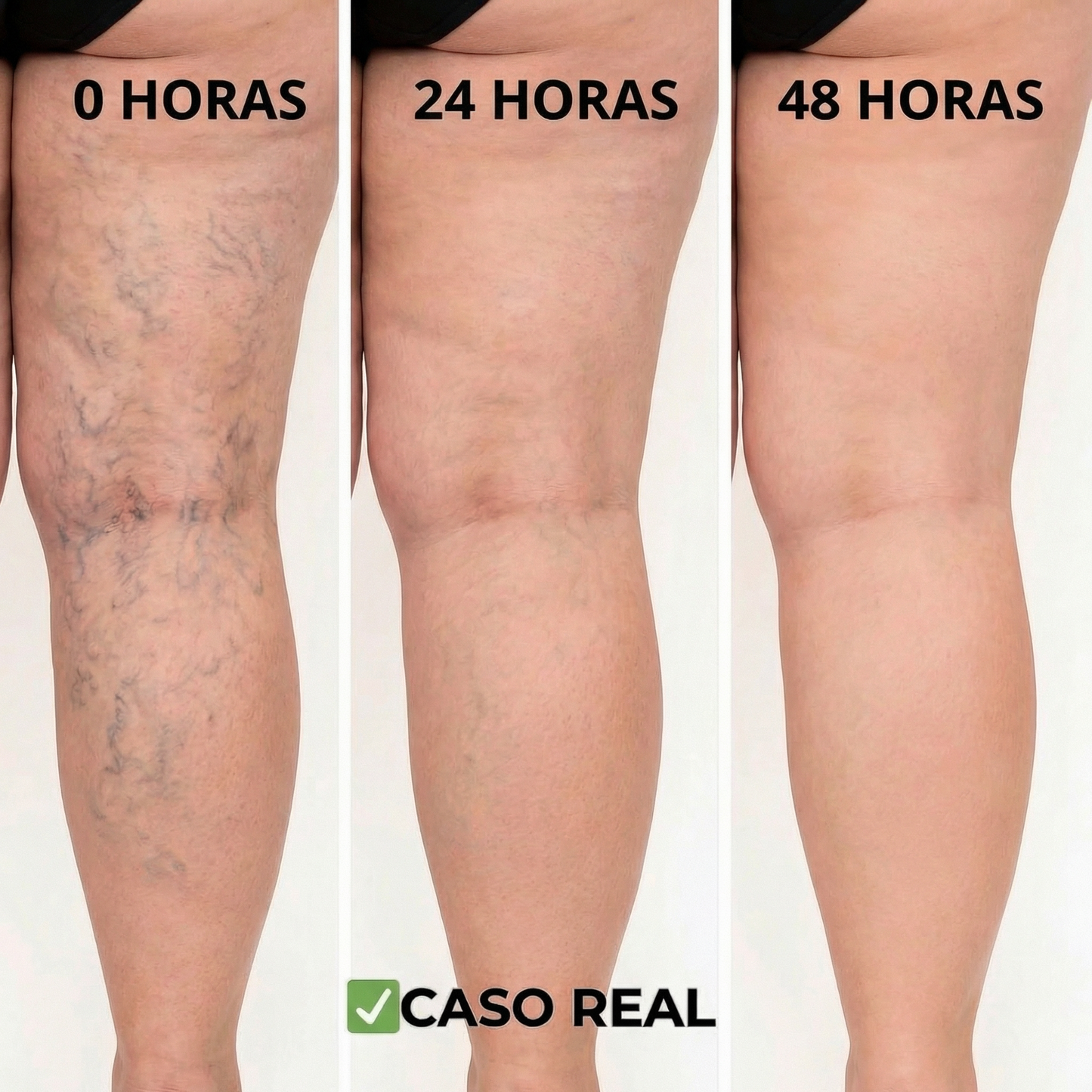 Parches Naturales para Varices y para las Piernas Cansadas - VeinPatch
