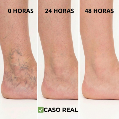 Parches Naturales para Varices y para las Piernas Cansadas - VeinPatch